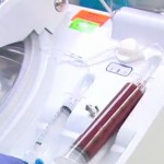Got Burned? How About Stem Cell Spray?