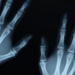 Engineers Use 3D Printer And Bone Like Material To Create New Bones (video)