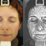UV Photography Reveals True Extent of Sun Damage