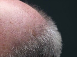 Baldness