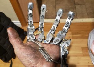 finger prosthetic