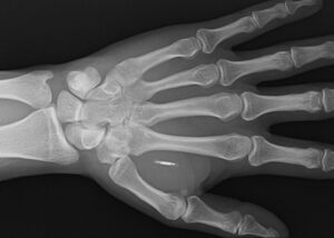 Biohacker contactless payment chip